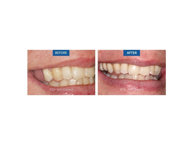 Partial Dentures Before And After Winterset IA 50273